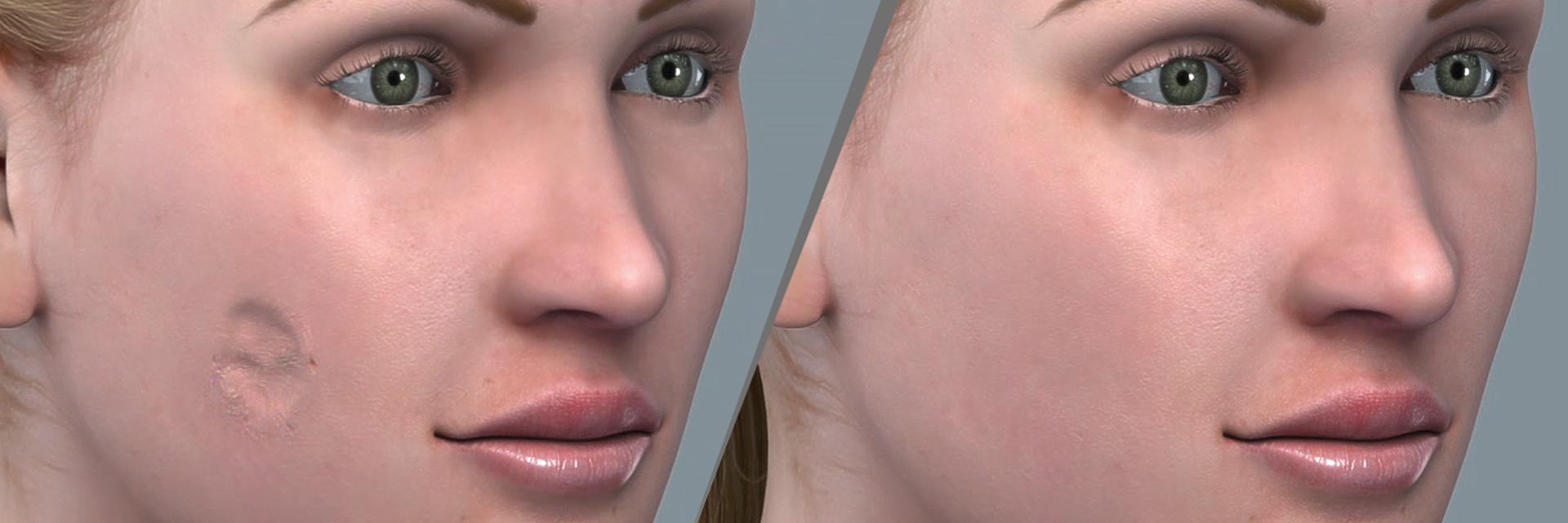 Restoration of Facial Skin Defects