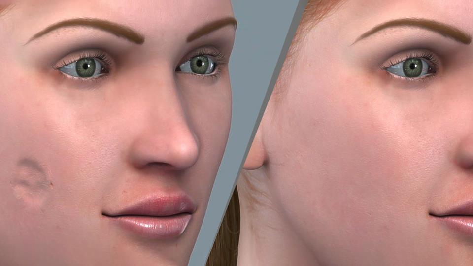 Restoration of Facial Skin Defects